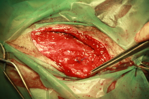 Hernia inguinal.